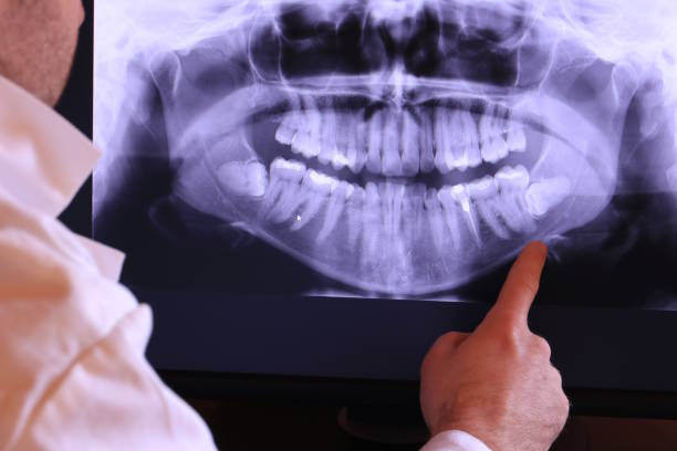 Best Emergency Tooth Extraction in Buckhannon, WV