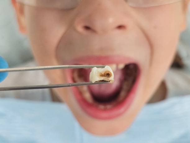 Best Emergency Treatment for Dental Infections or Abscesses in Buckhannon, WV