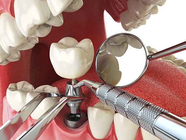 Best Urgent Care for Lost Fillings or Crowns in Buckhannon, WV